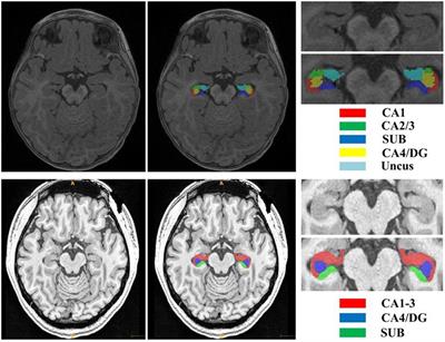 Dilated Dense U-Net for Infant Hippocampus Subfield Segmentation